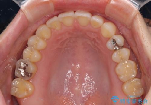【モニター】狭い上顎歯列とオープンバイト 急速拡大装置を用いた矯正治療の治療後
