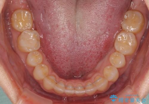 【モニター】狭い上顎歯列とオープンバイト 急速拡大装置を用いた矯正治療の治療後