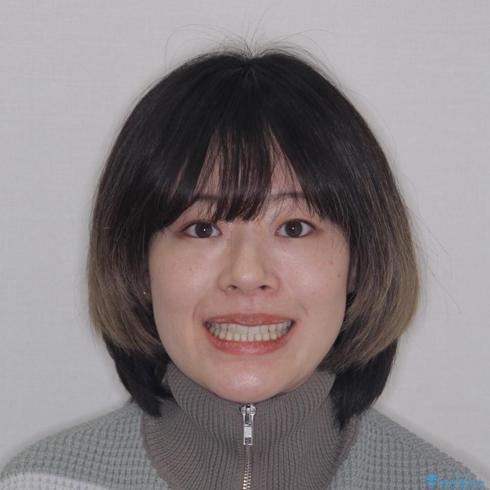 【モニター】狭い上顎歯列とオープンバイト 急速拡大装置を用いた矯正治療の治療後(顔貌)