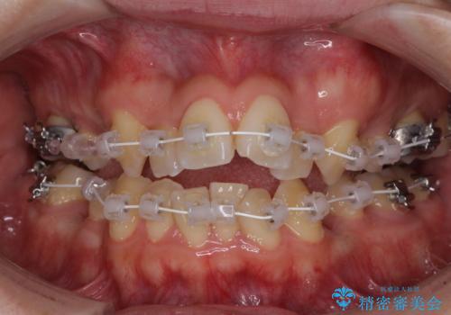 重なり合って磨きにくい前歯 ワイヤー装置での抜歯矯正の治療中