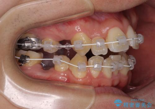 重なり合って磨きにくい前歯 ワイヤー装置での抜歯矯正の治療中