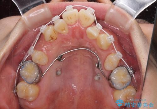重なり合って磨きにくい前歯 ワイヤー装置での抜歯矯正の治療中