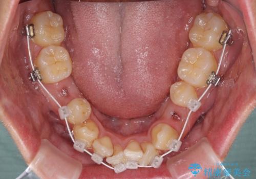 重なり合って磨きにくい前歯　ワイヤー装置での抜歯矯正の治療中