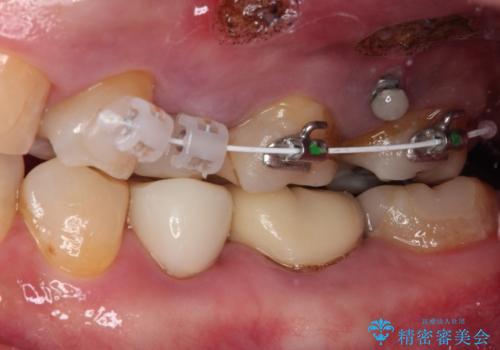 詰め物の外れてしまった奥歯 部分矯正で歯列を整えてから補綴治療の治療中