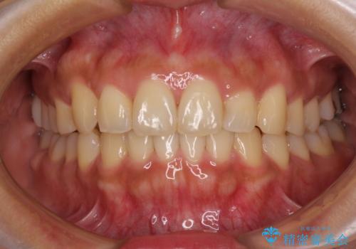 【モニター】歯列が狭くデコボコが気になる 急速拡大装置を用いたインビザライン矯正の治療後