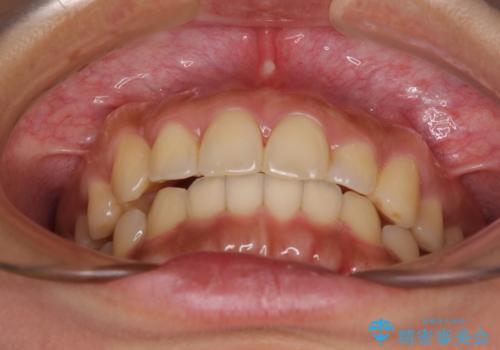 【モニター】歯列が狭くデコボコが気になる 急速拡大装置を用いたインビザライン矯正の治療後