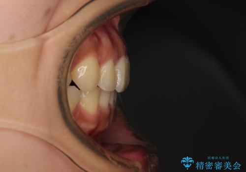 【モニター】歯列が狭くデコボコが気になる 急速拡大装置を用いたインビザライン矯正の治療後