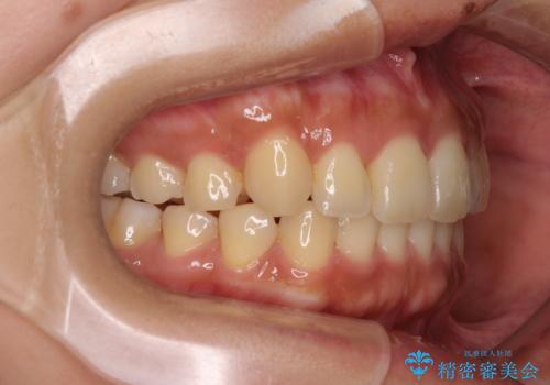 【モニター】歯列が狭くデコボコが気になる 急速拡大装置を用いたインビザライン矯正の治療後