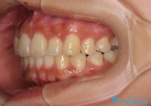 【モニター】歯列が狭くデコボコが気になる 急速拡大装置を用いたインビザライン矯正の治療後