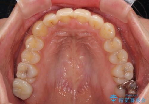 【モニター】歯列が狭くデコボコが気になる 急速拡大装置を用いたインビザライン矯正の治療後