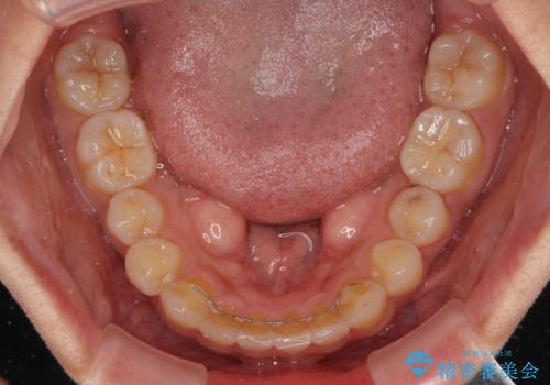 【モニター】歯列が狭くデコボコが気になる 急速拡大装置を用いたインビザライン矯正の治療後