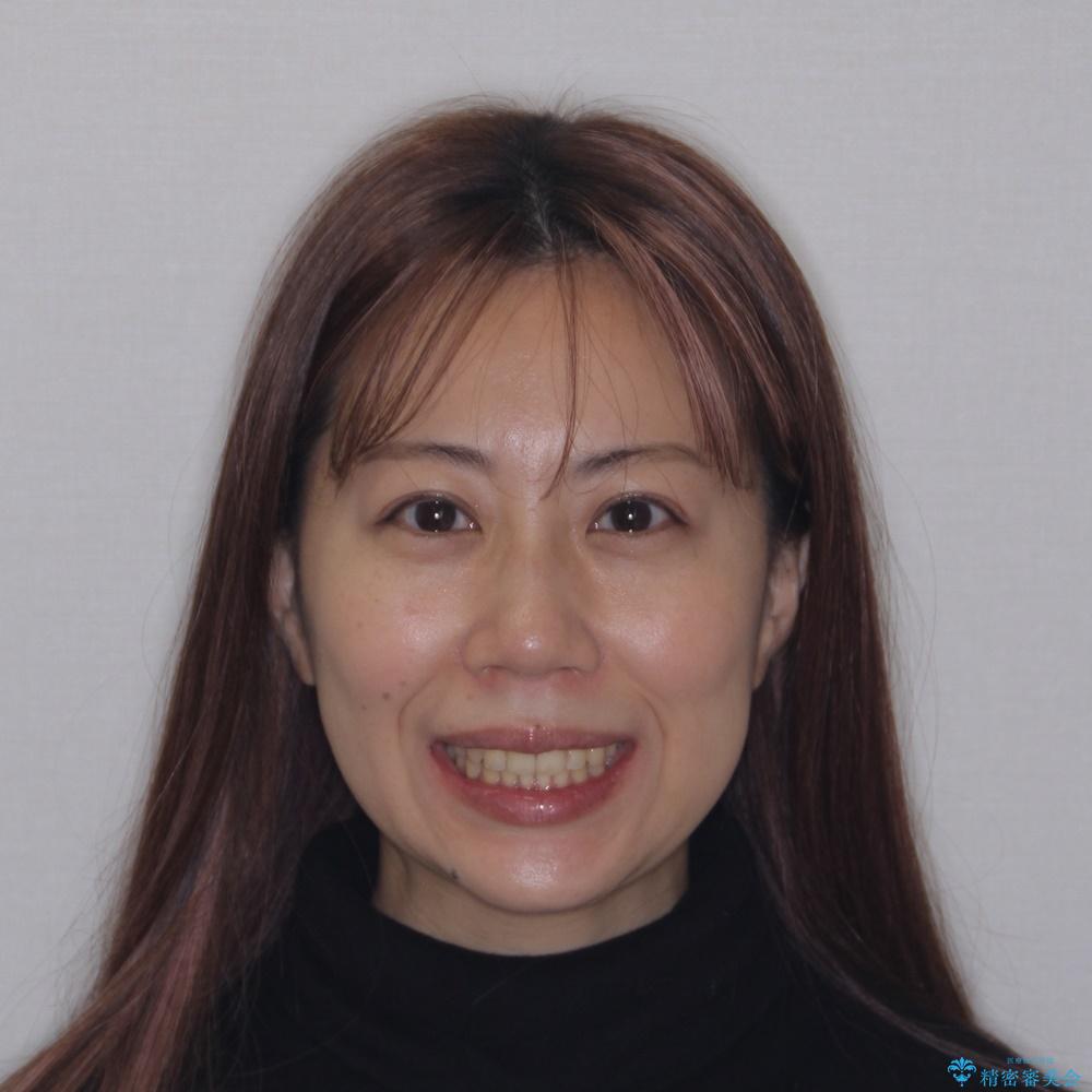 【モニター】歯列が狭くデコボコが気になる 急速拡大装置を用いたインビザライン矯正の治療後(顔貌)