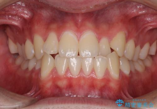 受け口傾向の咬み合わせ インビザラインできれいな口元にの症例 治療前