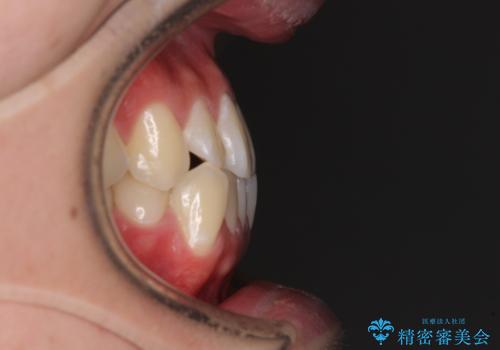 受け口傾向の咬み合わせ インビザラインできれいな口元にの治療前