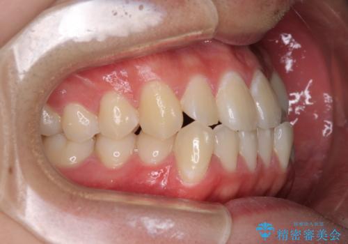 受け口傾向の咬み合わせ インビザラインできれいな口元にの治療前