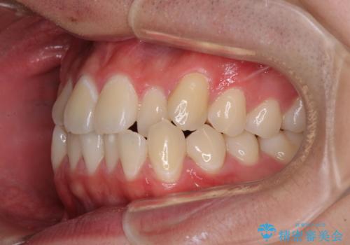 受け口傾向の咬み合わせ インビザラインできれいな口元にの治療前