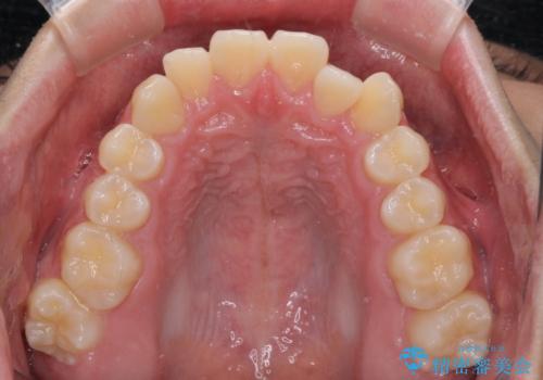 受け口傾向の咬み合わせ インビザラインできれいな口元にの治療前