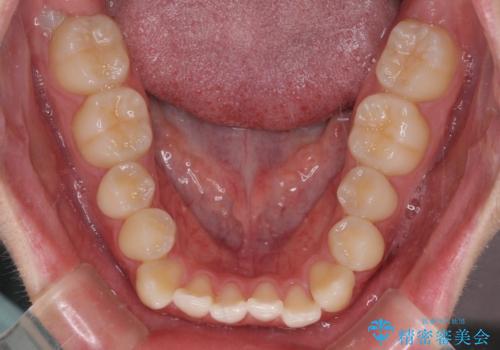 受け口傾向の咬み合わせ インビザラインできれいな口元にの治療前