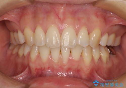 前歯のデコボコを抜歯矯正で改善　メタル装置で費用を抑えるの症例 治療後