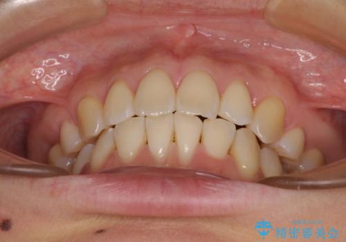 前歯のデコボコを抜歯矯正で改善 メタル装置で費用を抑えるの治療後