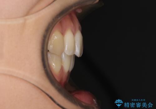 前歯のデコボコを抜歯矯正で改善 メタル装置で費用を抑えるの治療後