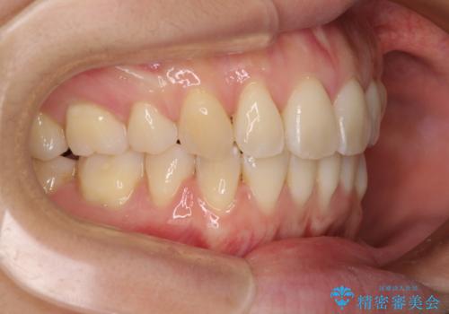 前歯のデコボコを抜歯矯正で改善　メタル装置で費用を抑えるの治療後