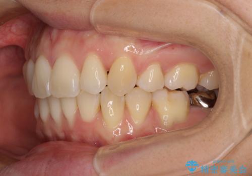 前歯のデコボコを抜歯矯正で改善 メタル装置で費用を抑えるの治療後