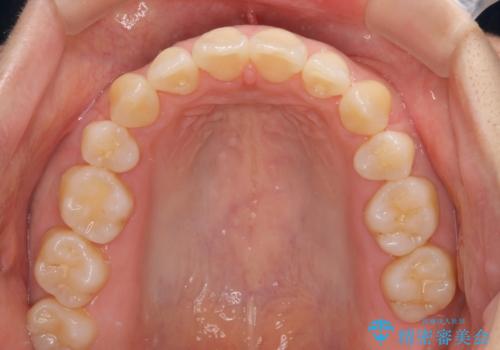 前歯のデコボコを抜歯矯正で改善 メタル装置で費用を抑えるの治療後