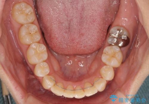 前歯のデコボコを抜歯矯正で改善 メタル装置で費用を抑えるの治療後