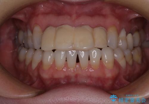 ひどすぎる前歯の仮歯　オールセラミッククラウンで自然な前歯にの治療前