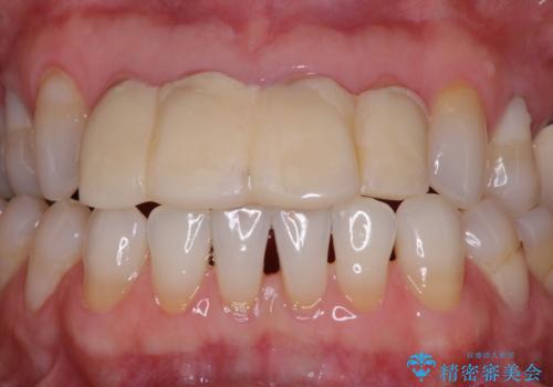 ひどすぎる前歯の仮歯 オールセラミッククラウンで自然な前歯にの治療前