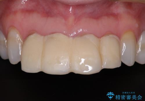 ひどすぎる前歯の仮歯 オールセラミッククラウンで自然な前歯にの治療前