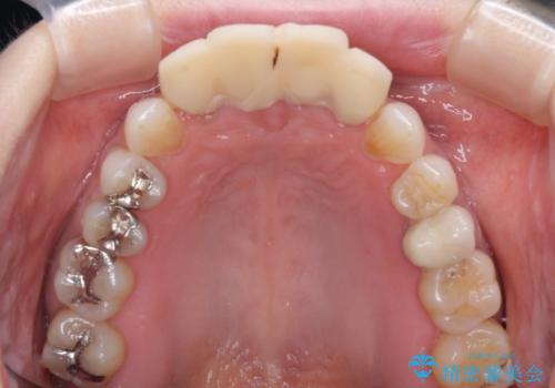 ひどすぎる前歯の仮歯 オールセラミッククラウンで自然な前歯にの治療前