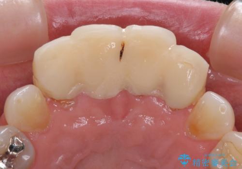 ひどすぎる前歯の仮歯　オールセラミッククラウンで自然な前歯にの治療前