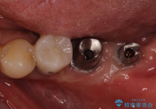 追加のインプラントと、歯肉移植による磨きやすい歯肉に改善の治療中