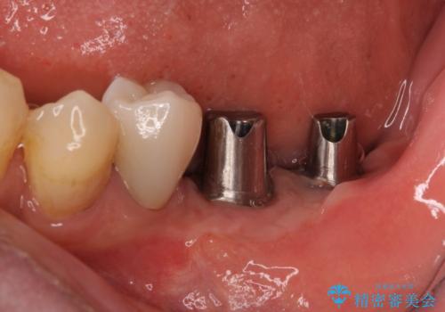 追加のインプラントと、歯肉移植による磨きやすい歯肉に改善の治療中
