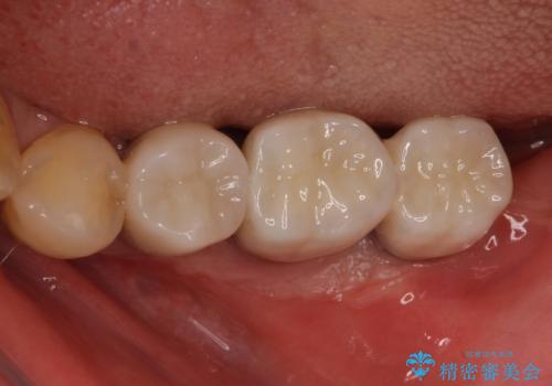 追加のインプラントと、歯肉移植による磨きやすい歯肉に改善の治療後