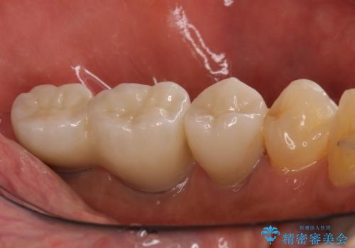 追加のインプラントと、歯肉移植による磨きやすい歯肉に改善の治療後