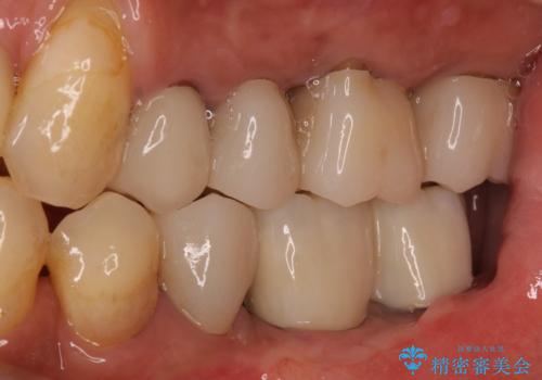 追加のインプラントと、歯肉移植による磨きやすい歯肉に改善の症例 治療後