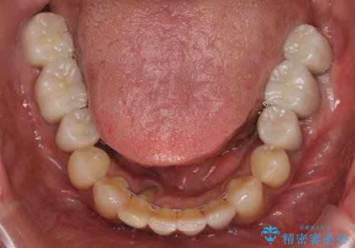 追加のインプラントと、歯肉移植による磨きやすい歯肉に改善の治療後