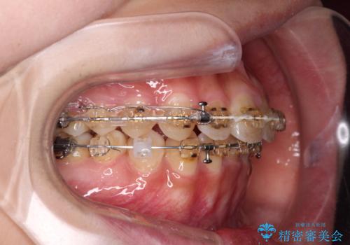 大学病院から転院 非抜歯で口元を下げるワイヤー矯正の治療中