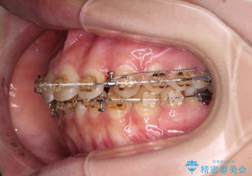大学病院から転院 非抜歯で口元を下げるワイヤー矯正の治療中