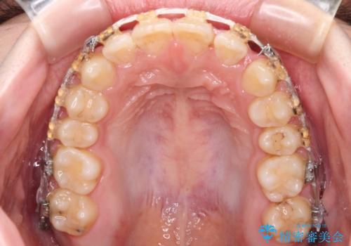 大学病院から転院 非抜歯で口元を下げるワイヤー矯正の治療中