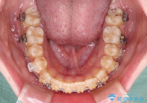 大学病院から転院 非抜歯で口元を下げるワイヤー矯正の治療中