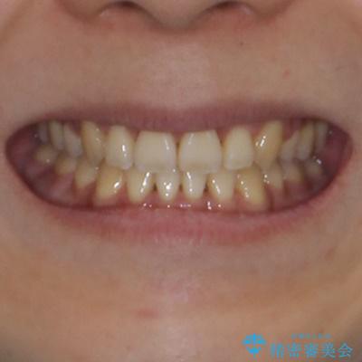 重なり合って磨きにくい前歯 ワイヤー装置での抜歯矯正の治療後(顔貌)