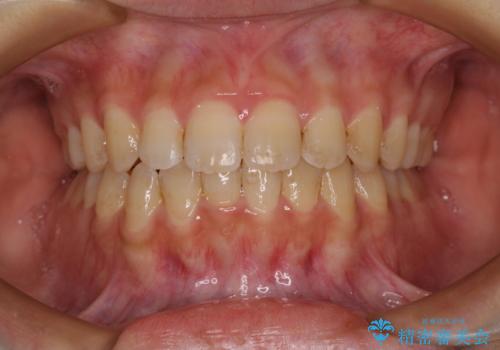 大学病院から転院 非抜歯で口元を下げるワイヤー矯正の治療後