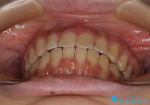 大学病院から転院 非抜歯で口元を下げるワイヤー矯正の治療後