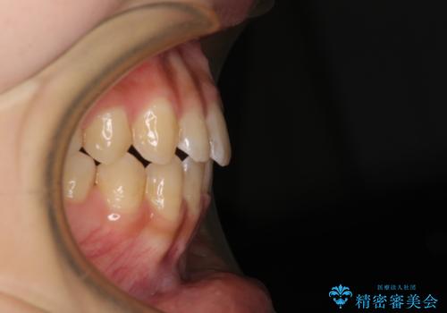 大学病院から転院 非抜歯で口元を下げるワイヤー矯正の治療後