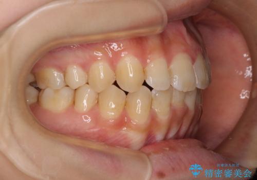 大学病院から転院 非抜歯で口元を下げるワイヤー矯正の治療後