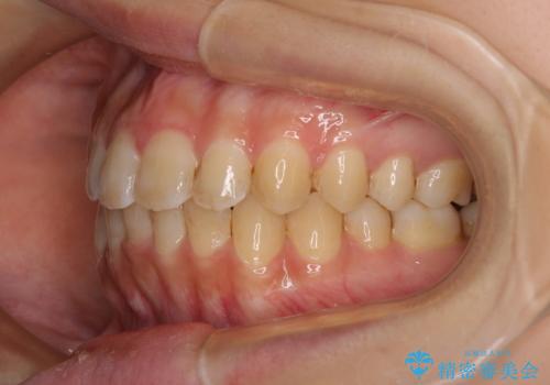 大学病院から転院 非抜歯で口元を下げるワイヤー矯正の治療後